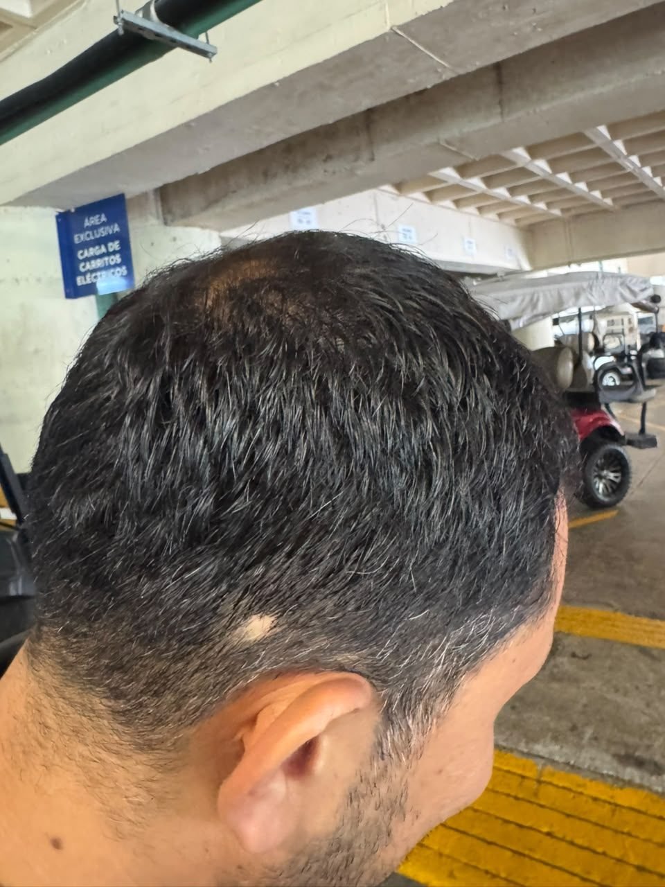 Cliente A, después del uso: vista lateral de la cabeza desde atrás